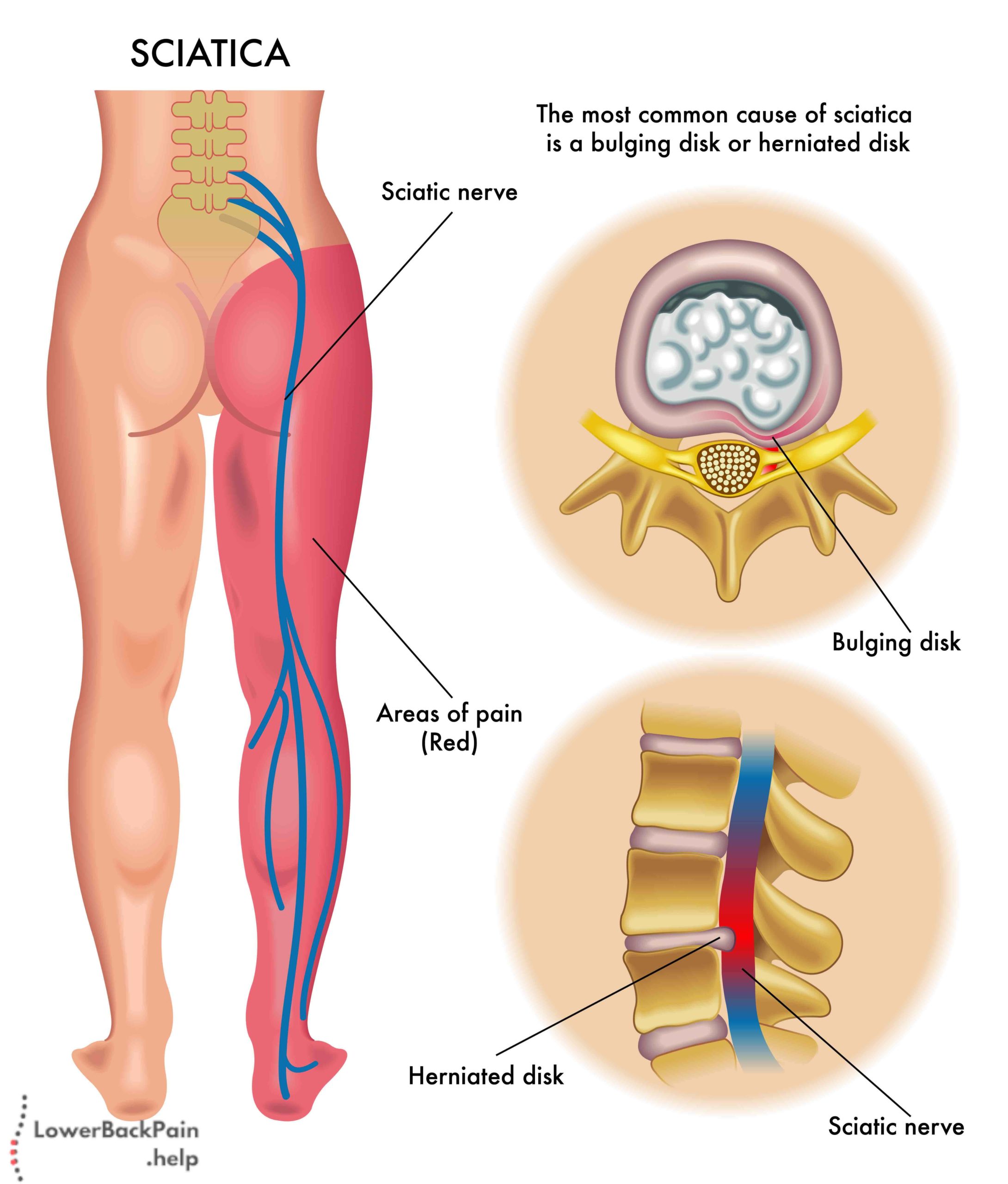 Sciatica Illustration