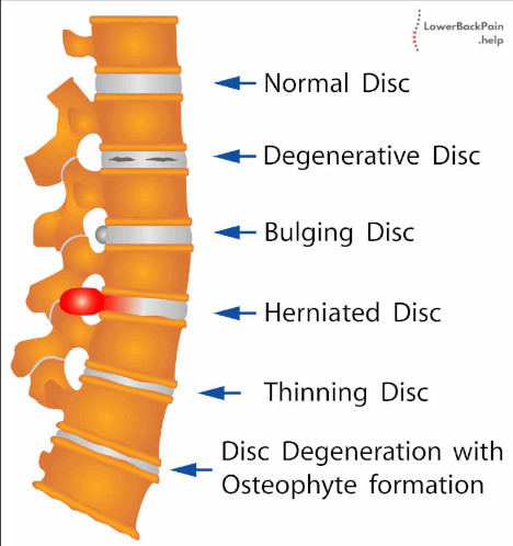 Different Types of Spine Conditions