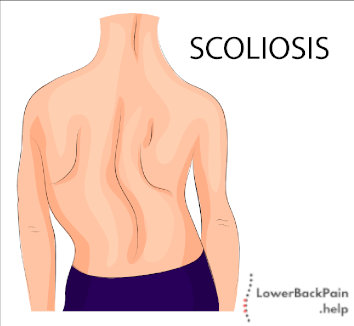 whats is scoliosis
