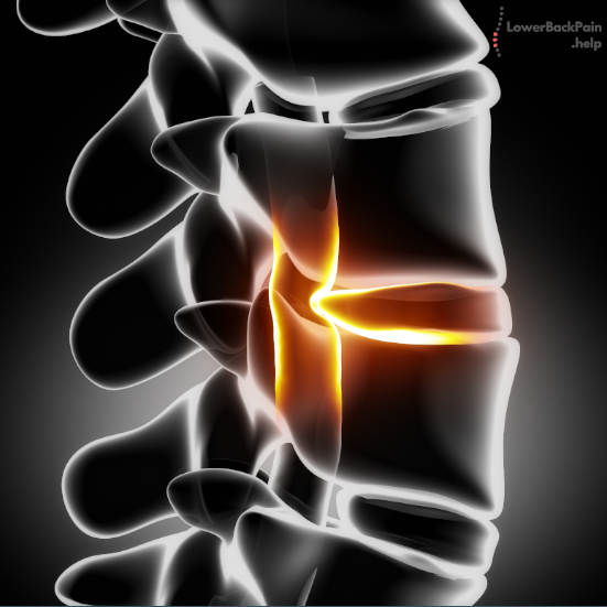 Herniated Disc