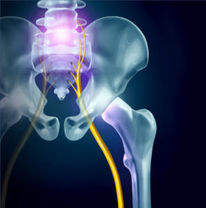 Sciatica has some unique pain symptoms